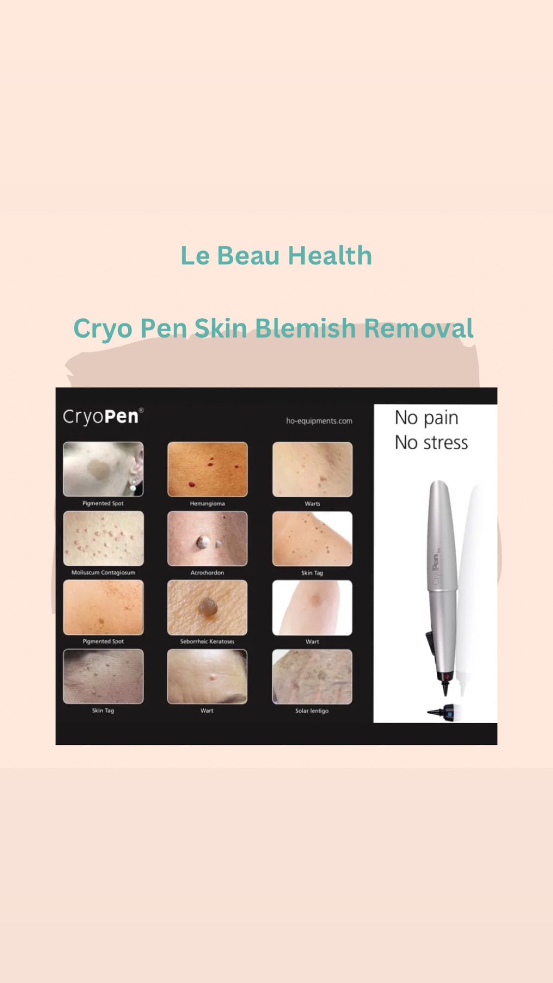CryoPen Lesion Removal Essex